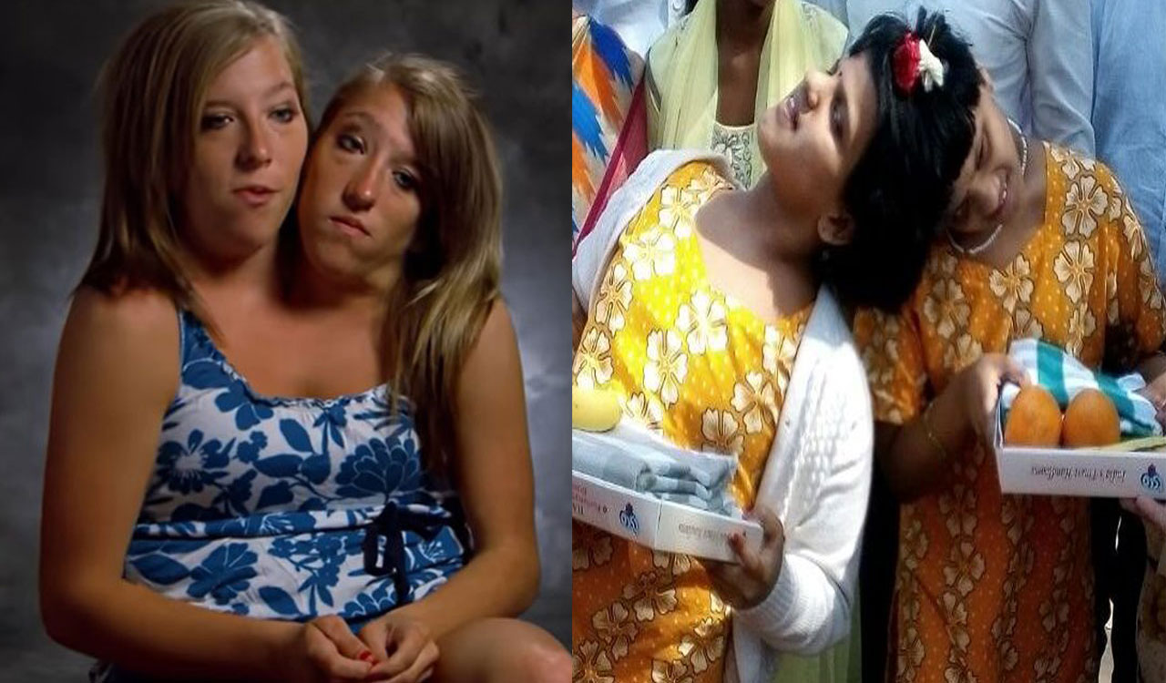 Veena and Vani: Hyderabad’s conjoined twins living quiet lives amid surgical risks