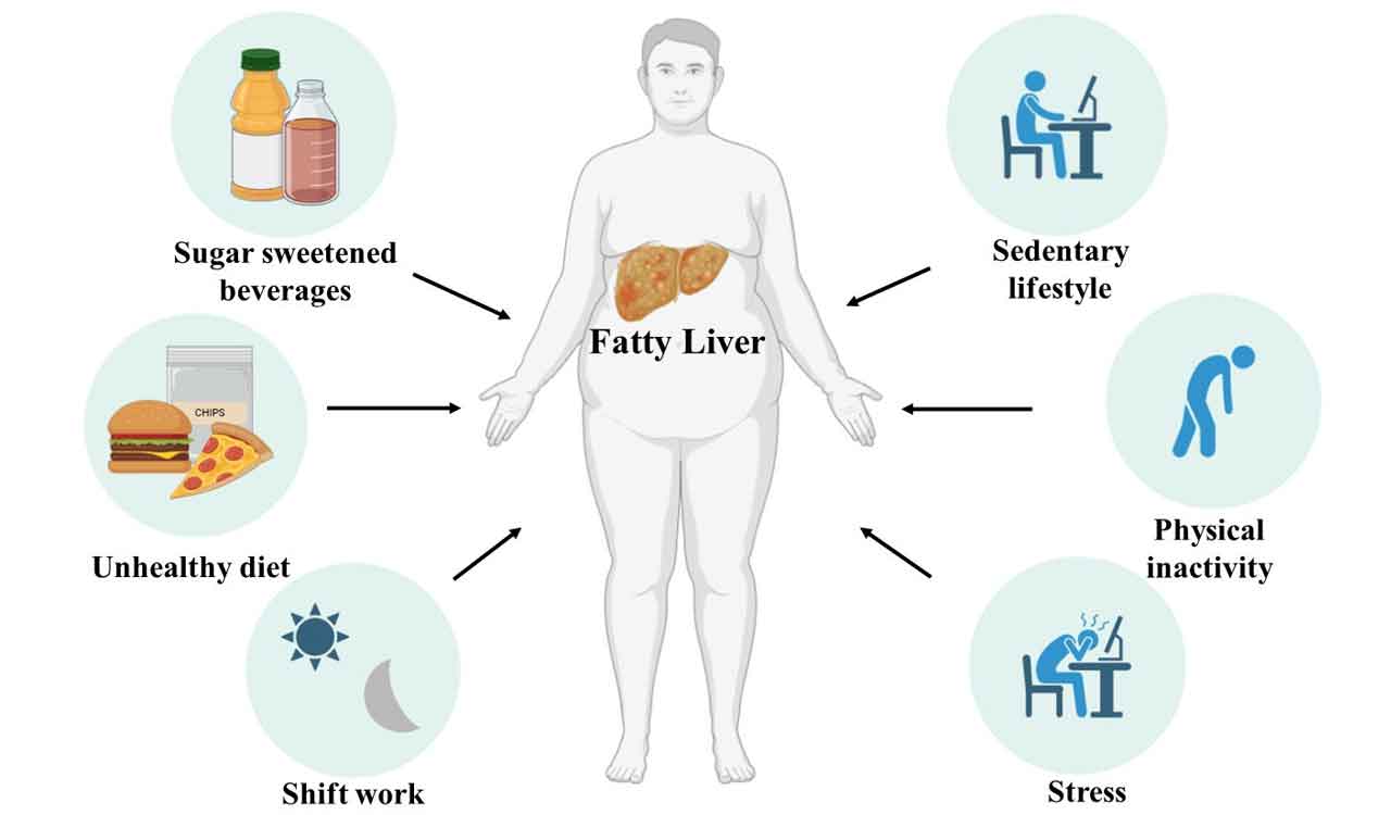 Over 80% of Indian IT workforce suffers from Fatty Liver Disease: UoH study