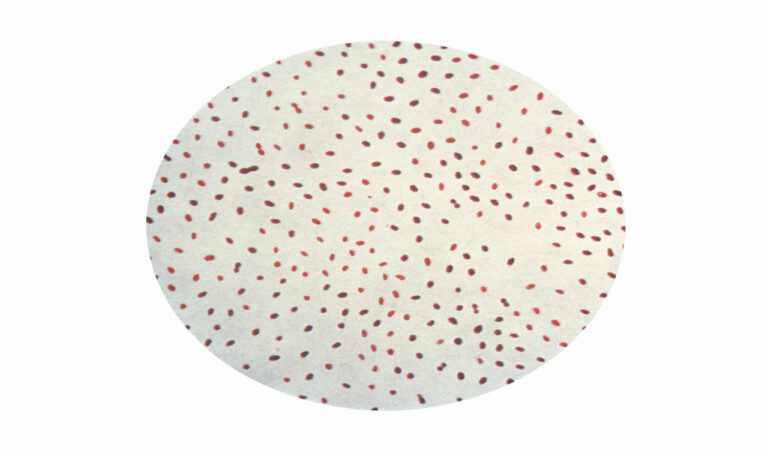 Telangana: Girl infected by brucella atypical virus in Sircilla