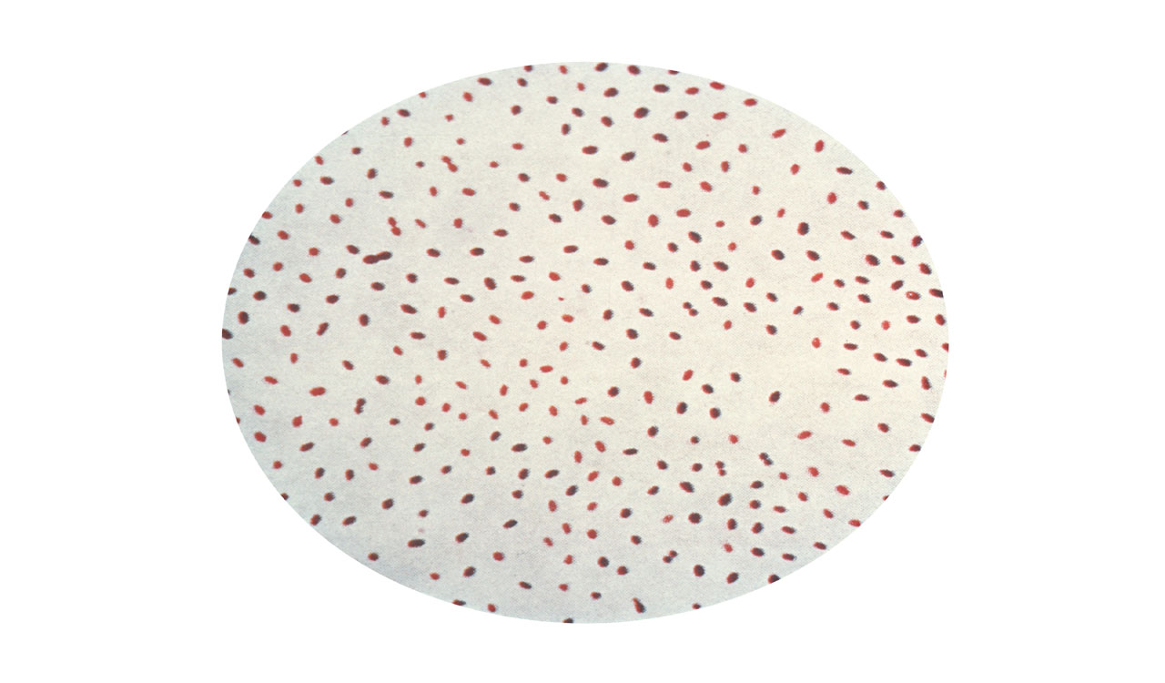 Telangana: Girl infected by brucella atypical virus in Sircilla