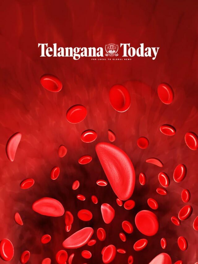 Sickle Cell Disease is a genetic condition that affects hemoglobin which carries oxygen in the body