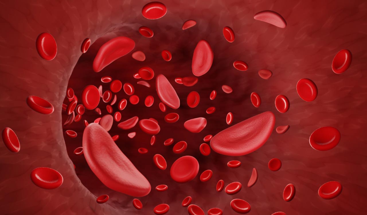 Sickle Cell disease highly prevalent among tribal population