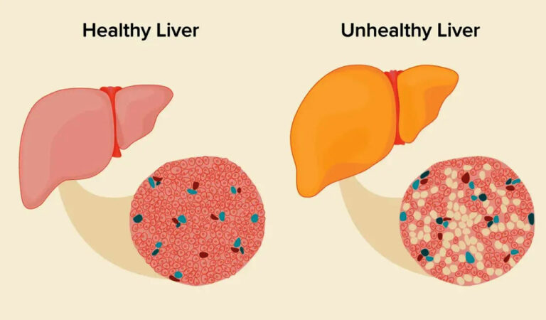 Non alcoholic fatty liver disease on the rise, Apollo Health of Nation report
