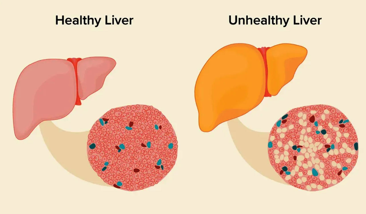 Non alcoholic fatty liver disease on the rise, Apollo Health of Nation report