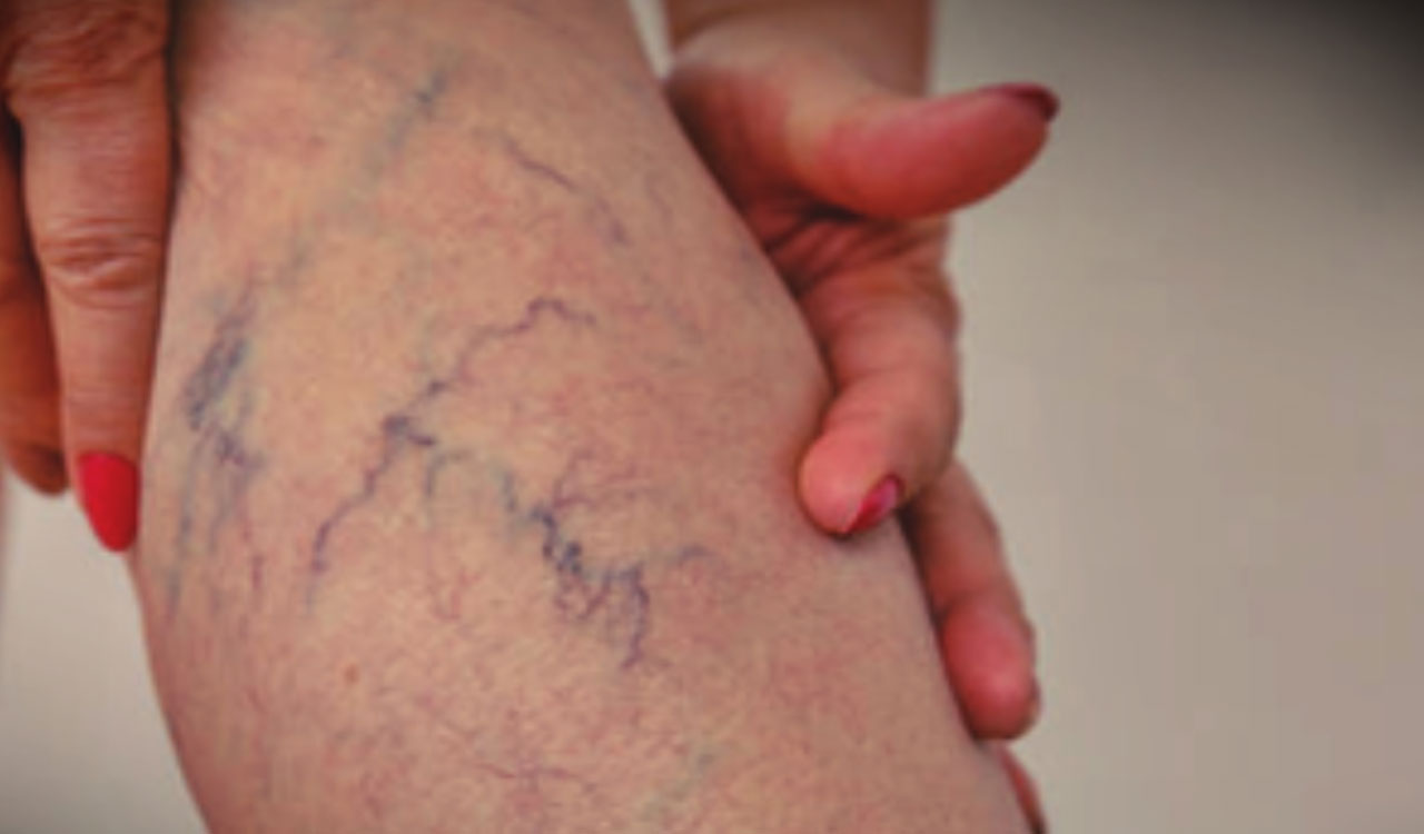 Ice-cold feet and heaviness in legs? It may signal varicose veins, says study