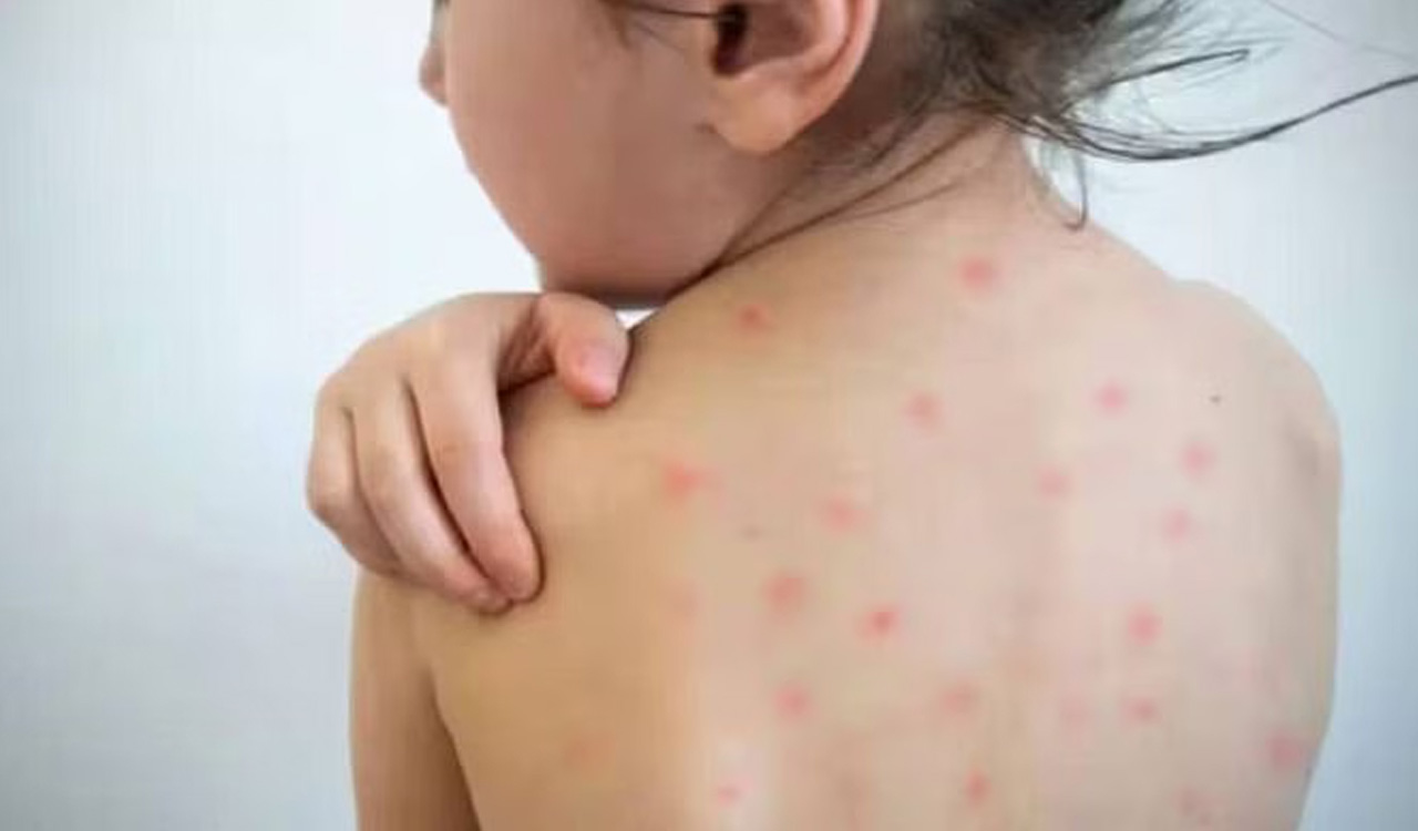 Measles cases surging globally. Should children be vaccinated earlier?