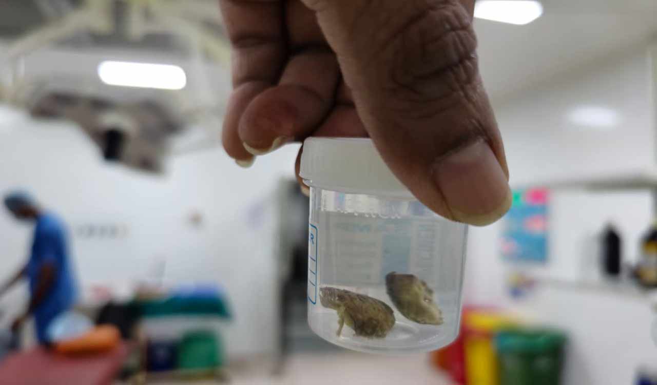 Hyderabad woman nearly dies after betel nut lodges in airway