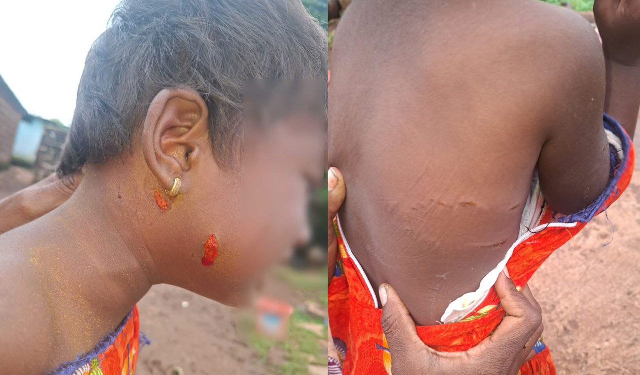 Four-year-old girl injured in stray dog attack in Sangareddy