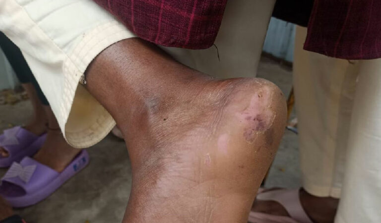 Rats bites eight students at tribal welfare residential school in Narsapur