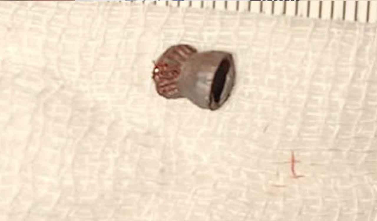 Hyderabad doctors successfully remove air gun pellet near 3-year-old’s eye