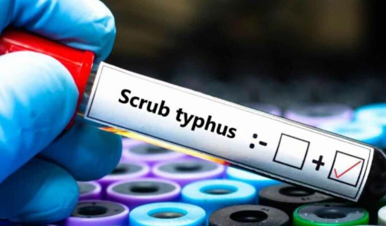 Scrub Typhus surge in Andhra Pradesh raises alert for Telangana residents