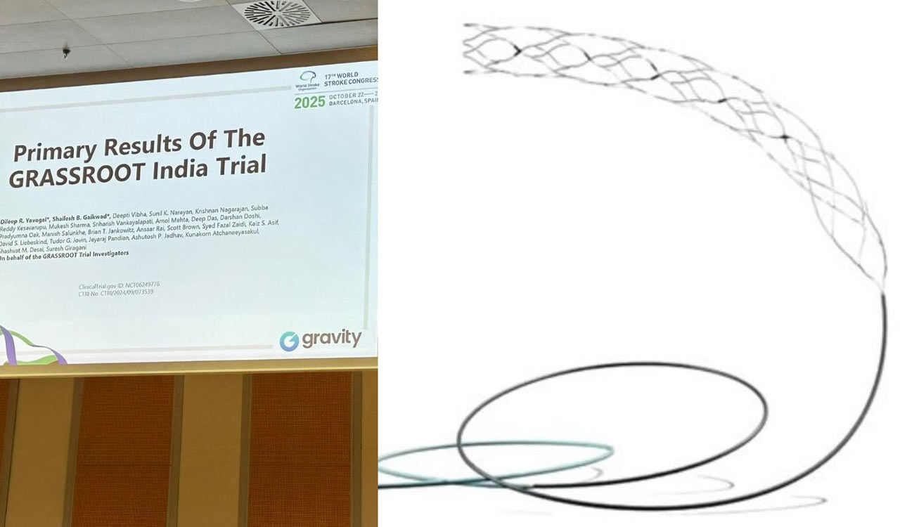 AIIMS-led trial proves Supernova Stent safe and effective for stroke patients