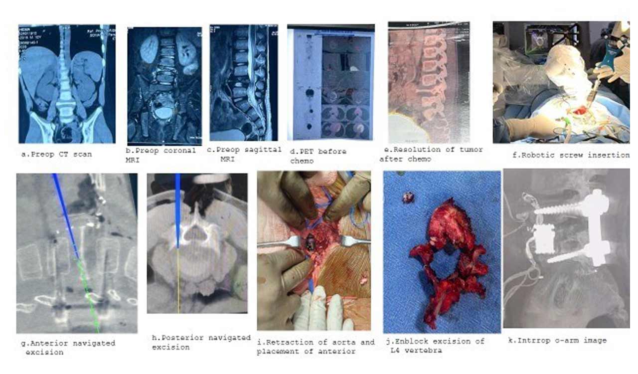 KIMS doctors perform robotic spine surgery on 10-year-old with rare cancer