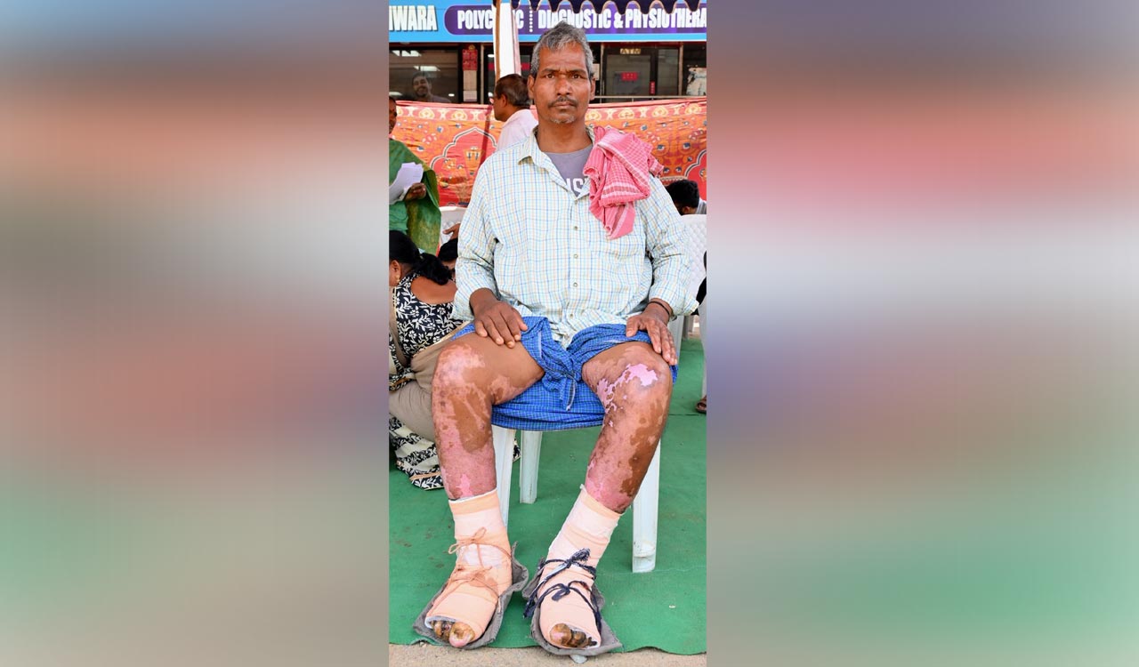 Sigachi blast victims struggle to rebuild lives as injured workers seek higher compensation