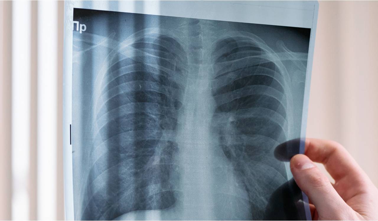 Drone tech slashes TB patient costs from Rs 9,451 to Rs 91: AIIMS Bibinagar–ICMR study